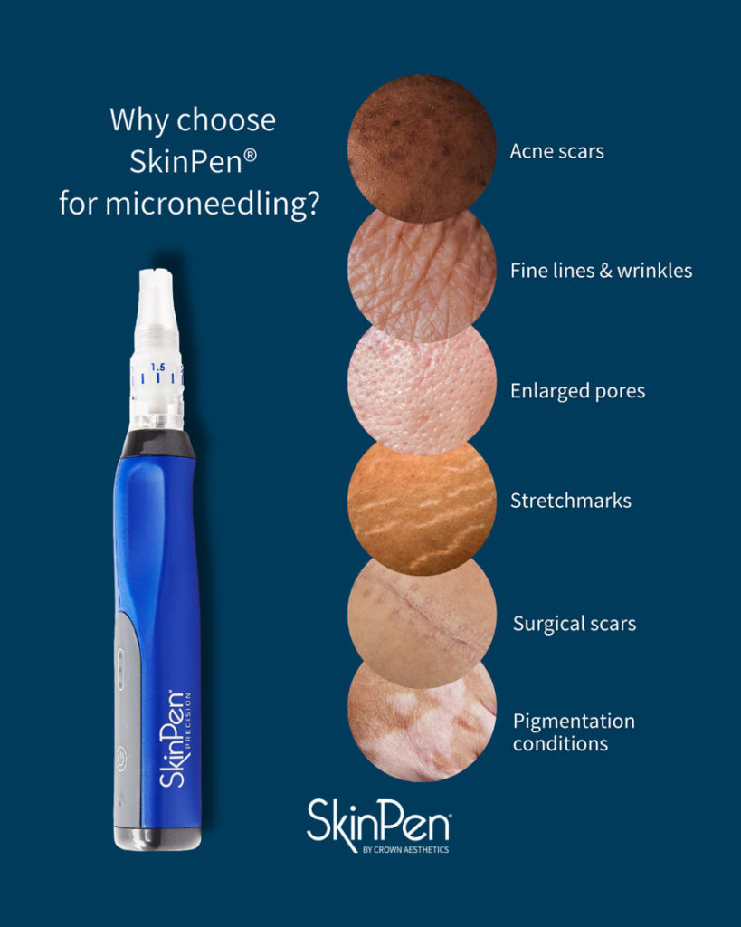 SkinPen Microneedling Treatment - Skinology Medical Aesthetics Clinic - London UK - 5
